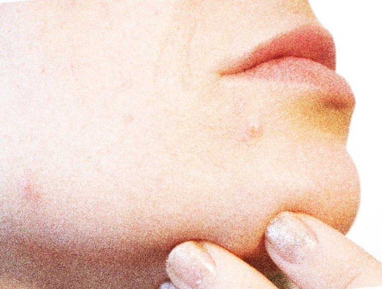 Acne example